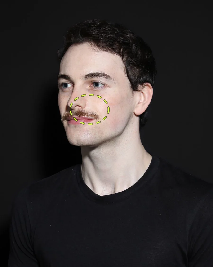 A patient photograph with the cheek filler area marked