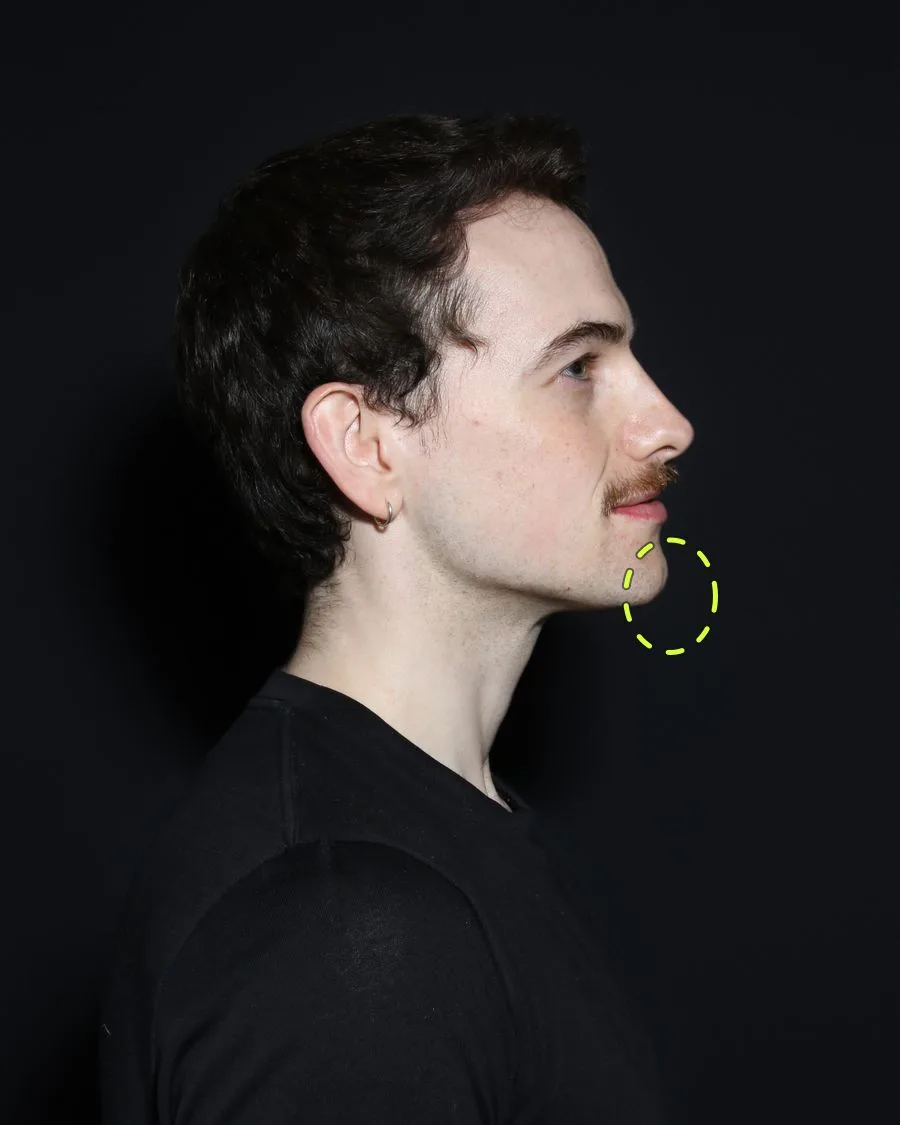 A patient photograph with the chin filler area marked