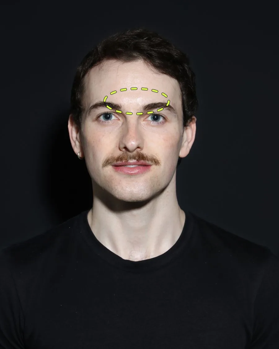 A patient photograph with the lines and wrinkles assessment area marked