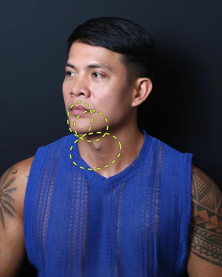 A patient photograph with the jaw, cheek and nose treatment areas marked