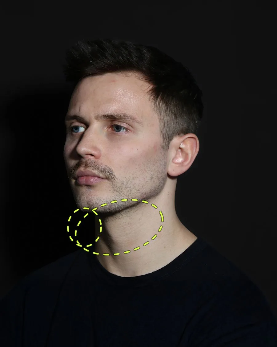 A patient photograph with the jawline filler area marked