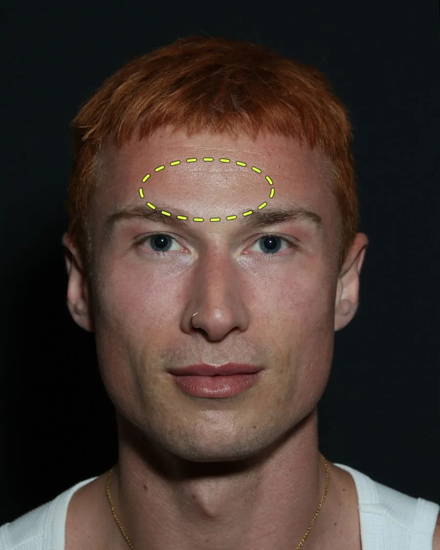 A patient photograph with the anti-wrinkle injections area marked