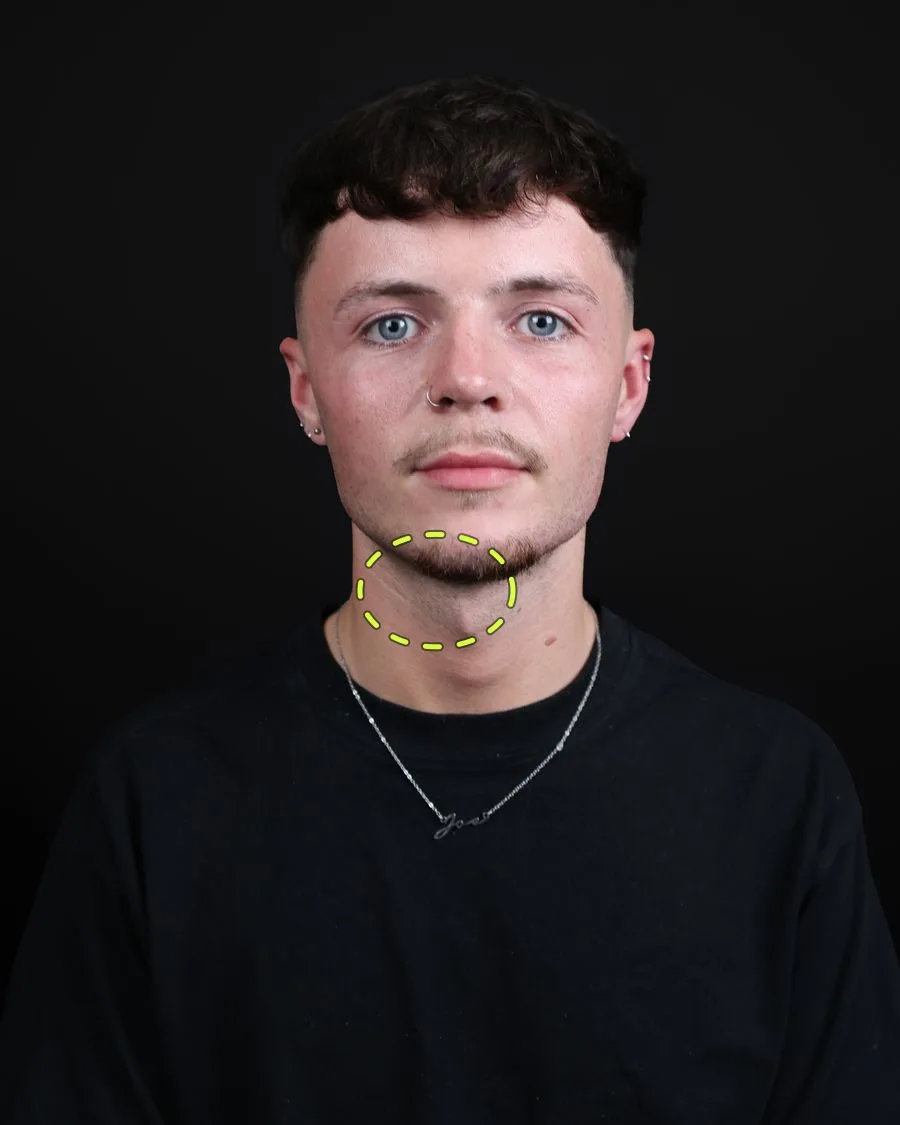 A patient photograph with the lip filler area marked