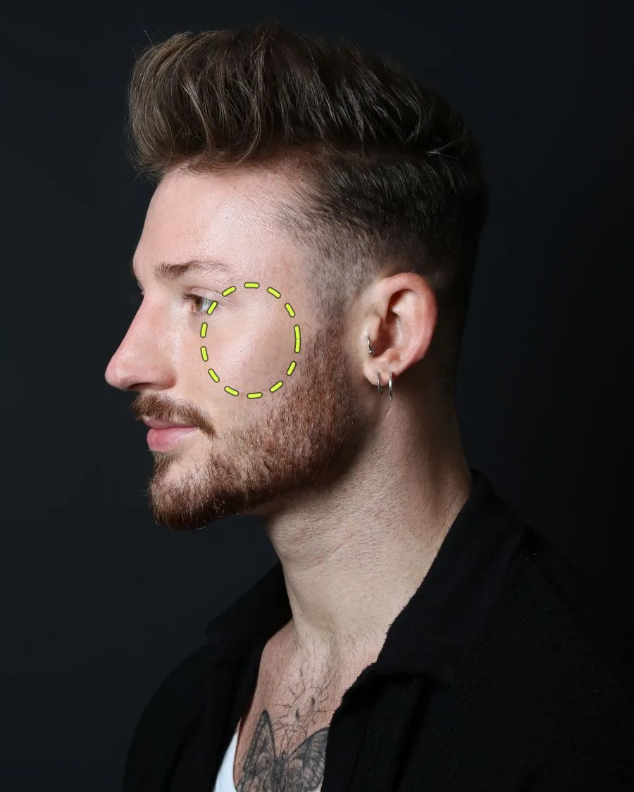 A patient photograph with the nose filler area marked