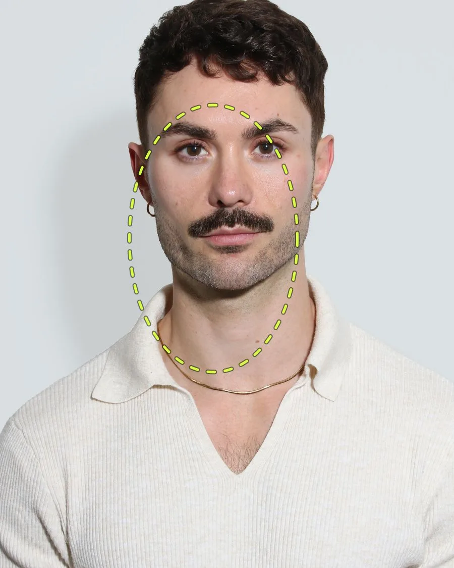 A patient photograph with the skin boosters area marked