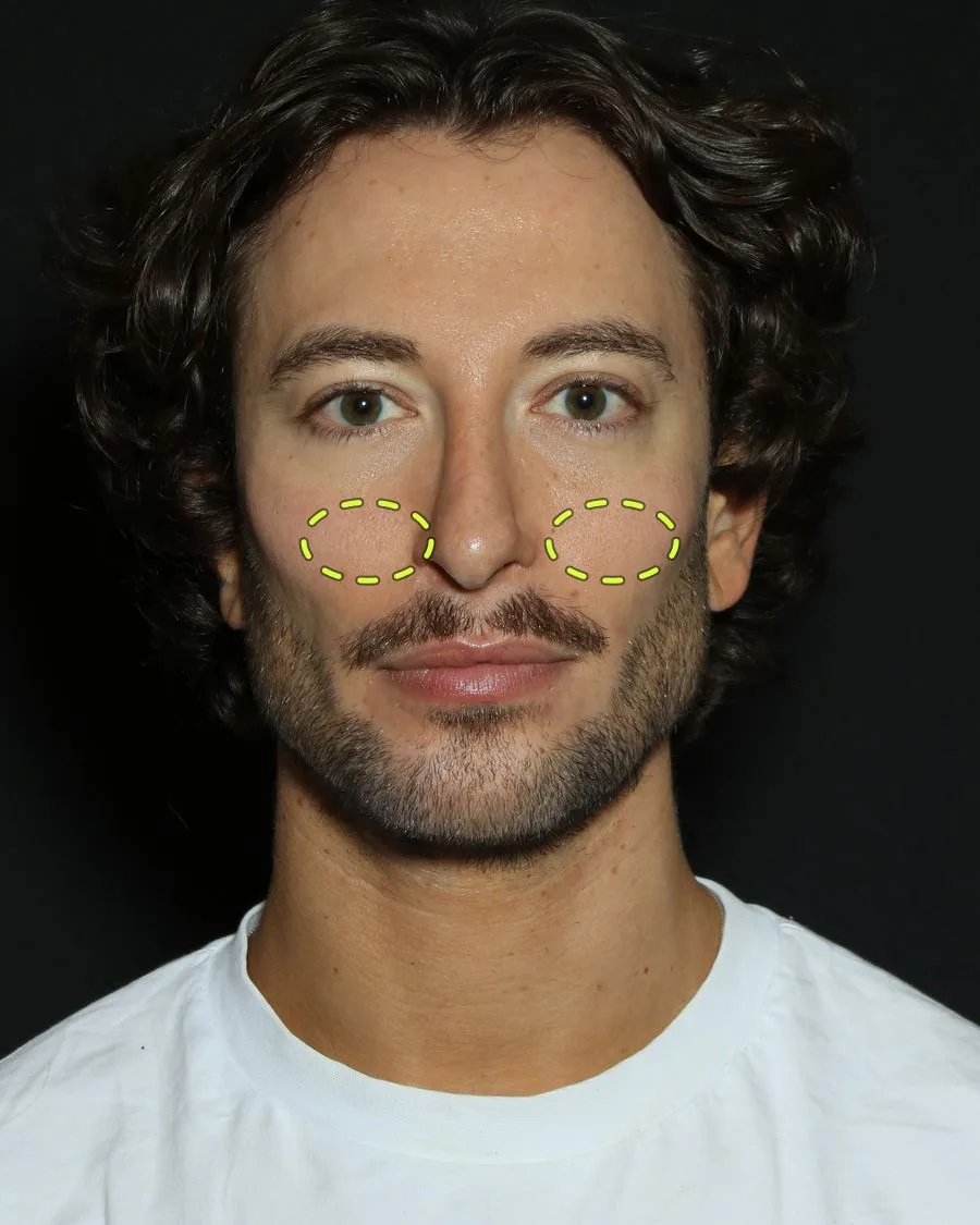 A patient photograph with the under-eye filler area marked
